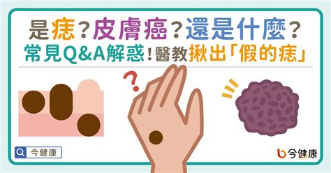 右下巴痣長毛|是痣？還是皮膚癌？皮膚科醫師教你揪出「假的痣」，。